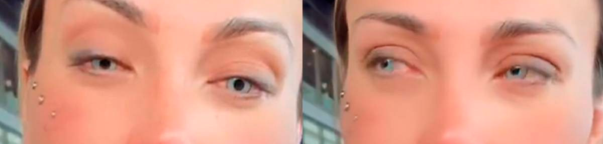 Close dos olhos de Andressa Urach com sinais de complicações após cirurgia estética