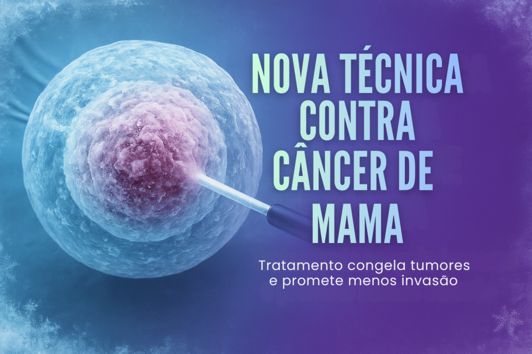 Tumor de mama sendo congelado durante procedimento de crioablação em novo tratamento testado no Brasil.